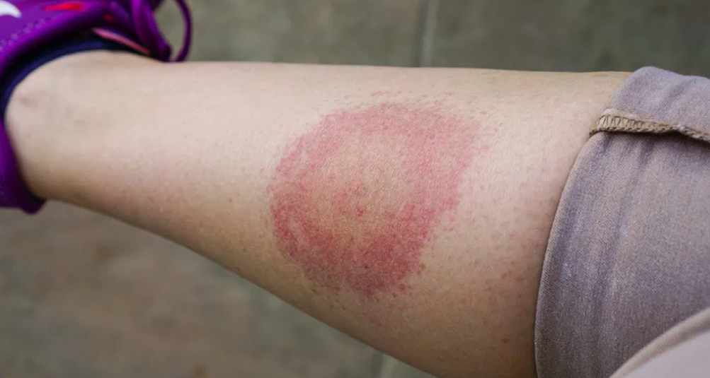 Lyme Disease