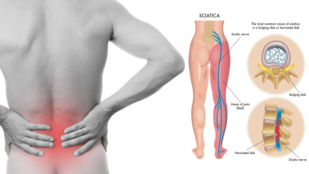 sciatica pain